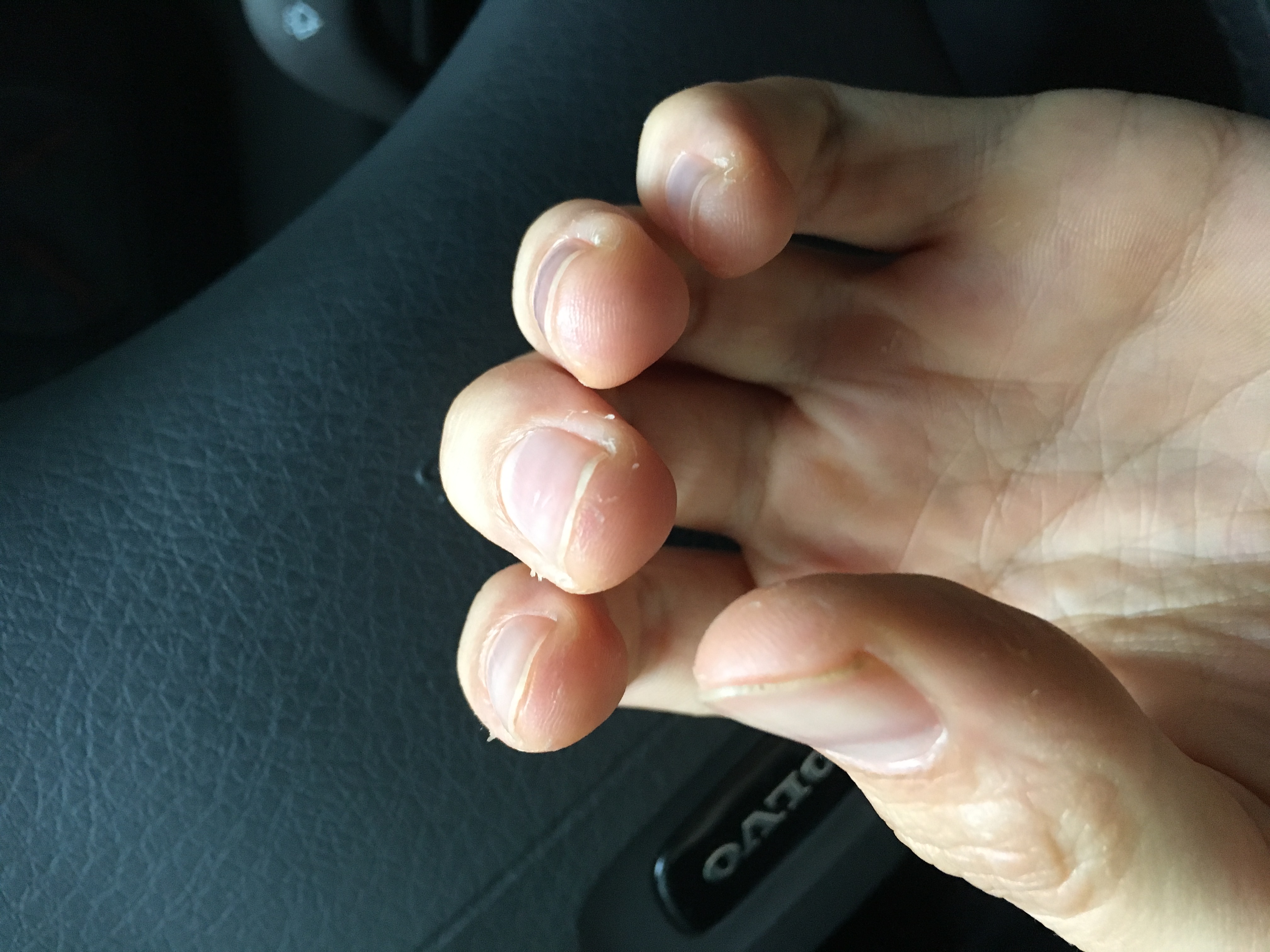 Wieso schält sich die Haut an meinen Händen? (Gesundheit, Gesundheit und Medizin, Ernährung)