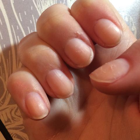wieso sehen meine nagel so aus kaputt nagellackentferner