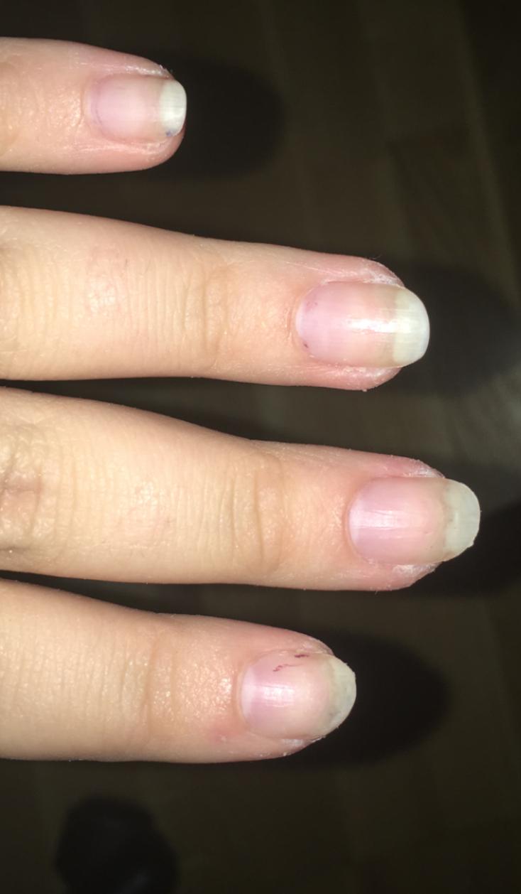 Wieso Sehen Meine Nagel So Komisch Aus Fingernagel