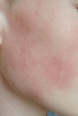 Wieso Standig Rote Wangen Gesundheit Und Medizin Korper Hautpflege