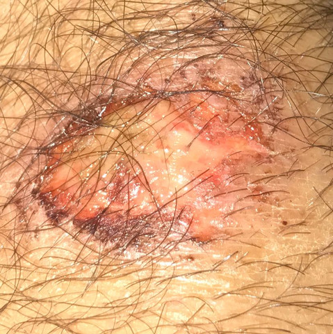 schürfwunde am knie - (Gesundheit, Gesundheit und Medizin, Knie)