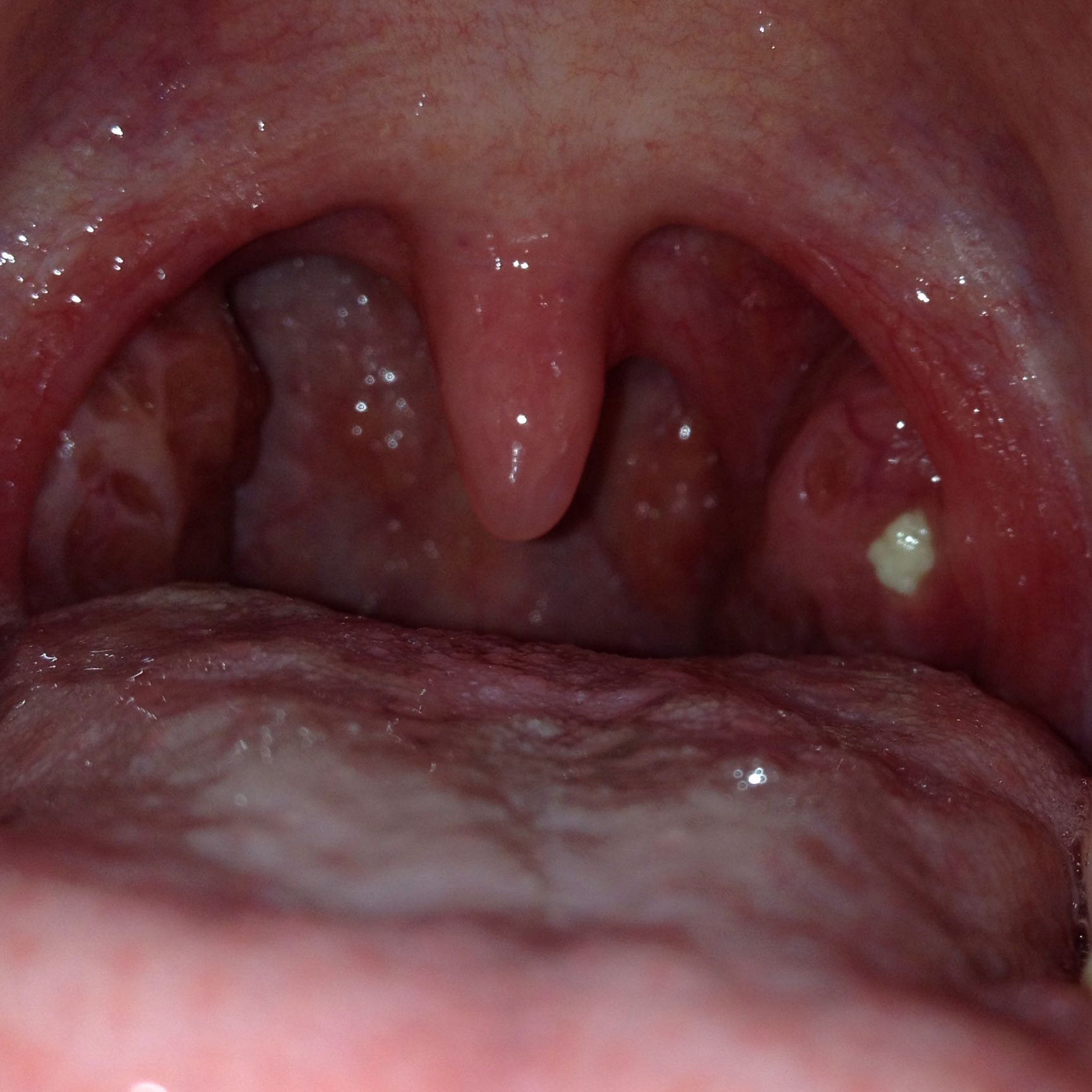 43++ Eiter im hals bilder , Wieso vergrössert sich die Eiterblase? (Mandeln, Rachenraum)