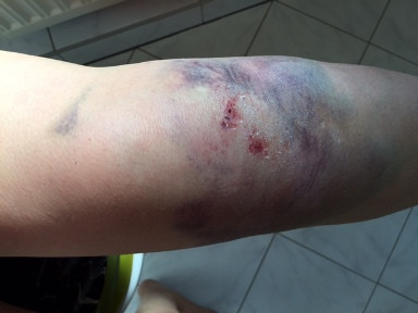 Knieverletzung links - (Schmerzen, Unfall, Verkehrsrecht)