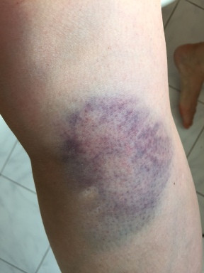 Knieverletzung rechts - (Schmerzen, Unfall, Verkehrsrecht)