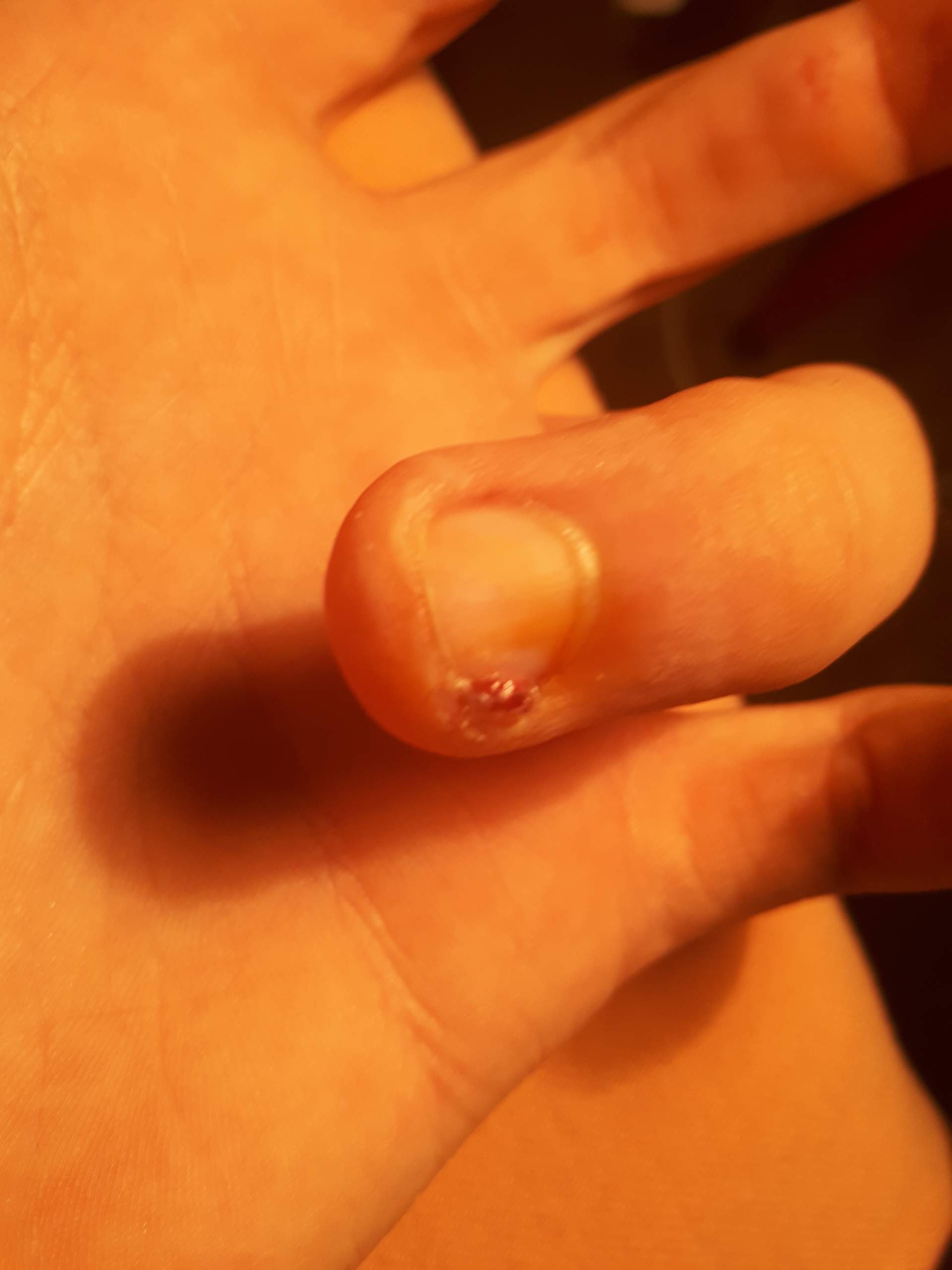 Finger nagelbettentzündung wildes fleisch Nagelbettentzündung