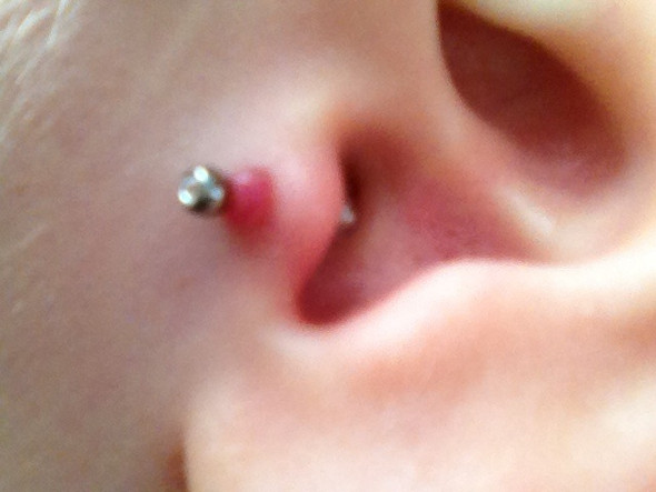 Wildes Fleisch Am Ohr Durch Welchen Arzt Zu Entfernen Piercing Operation Wildes Fleisch