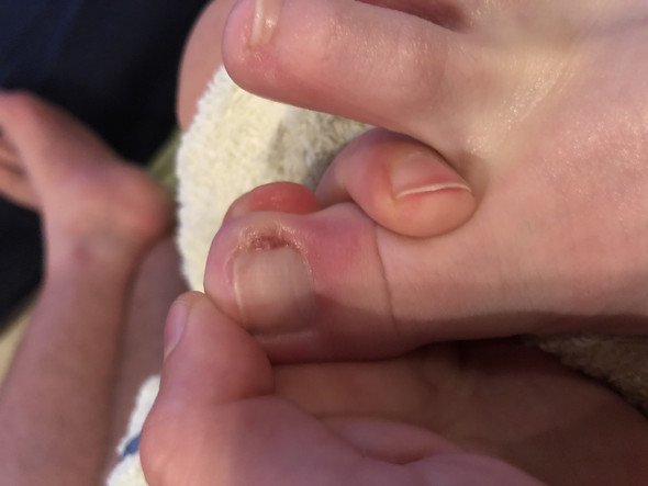 Wildes Fleisch Am Zeh Nach Nagelbettentzundung Gesundheit Und Medizin Arzt Entzundung Wildes Fleisch Am Zeh Nach Nagelbettentzundung Gesundheit Und Medizin Arzt Entzundung