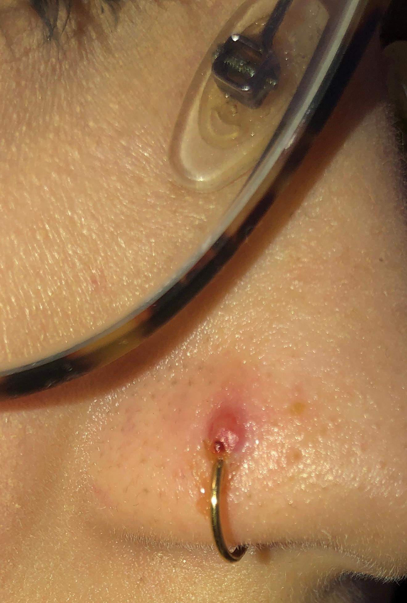 Gel piercing wildfleisch tyrosur Piercing entzündet\wildfleisch?