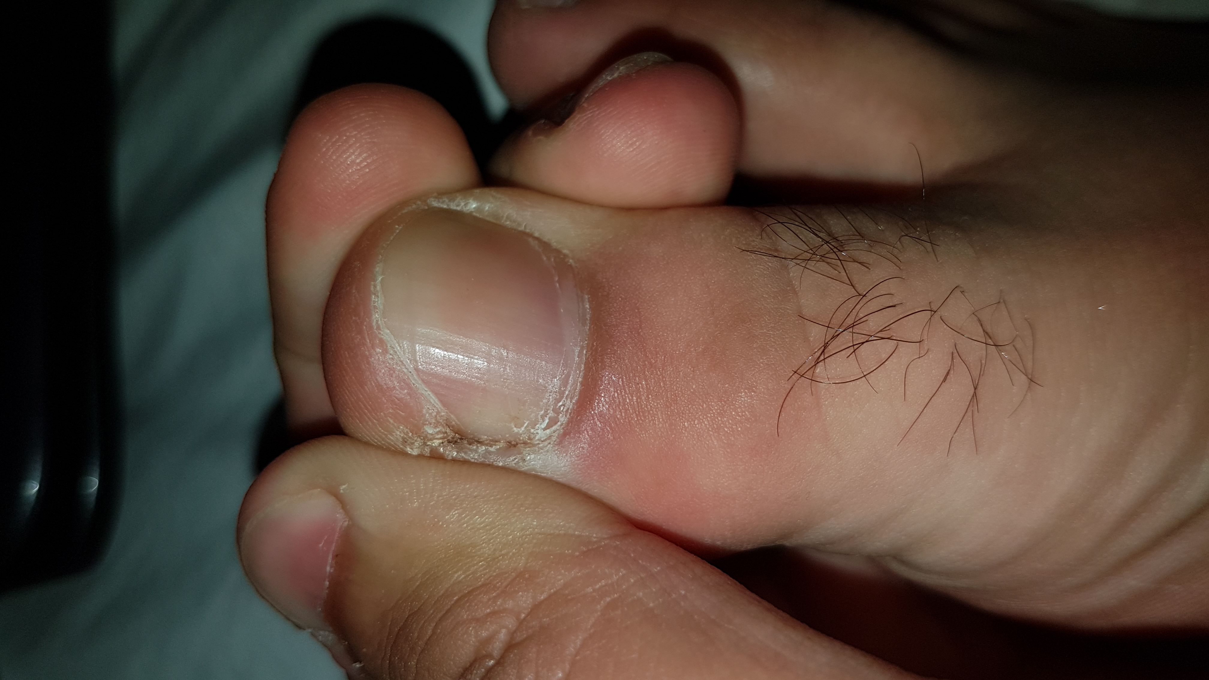 Will mein zeh nicht operien lassen was tun? (Füße, Entzündung) Will mein zeh nicht operien lassen was tun? (Füße, Entzündung)