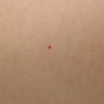 Winzig Roter Punkt Auf Dem Oberschenkel Krankheit Haut Blut Winzig Roter Punkt Auf Dem Oberschenkel Krankheit Haut Blut