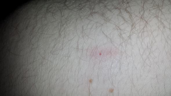 Winzige Rote Flecken Auf Der Haut Gesundheit Winzige Rote Flecken Auf Der Haut Gesundheit