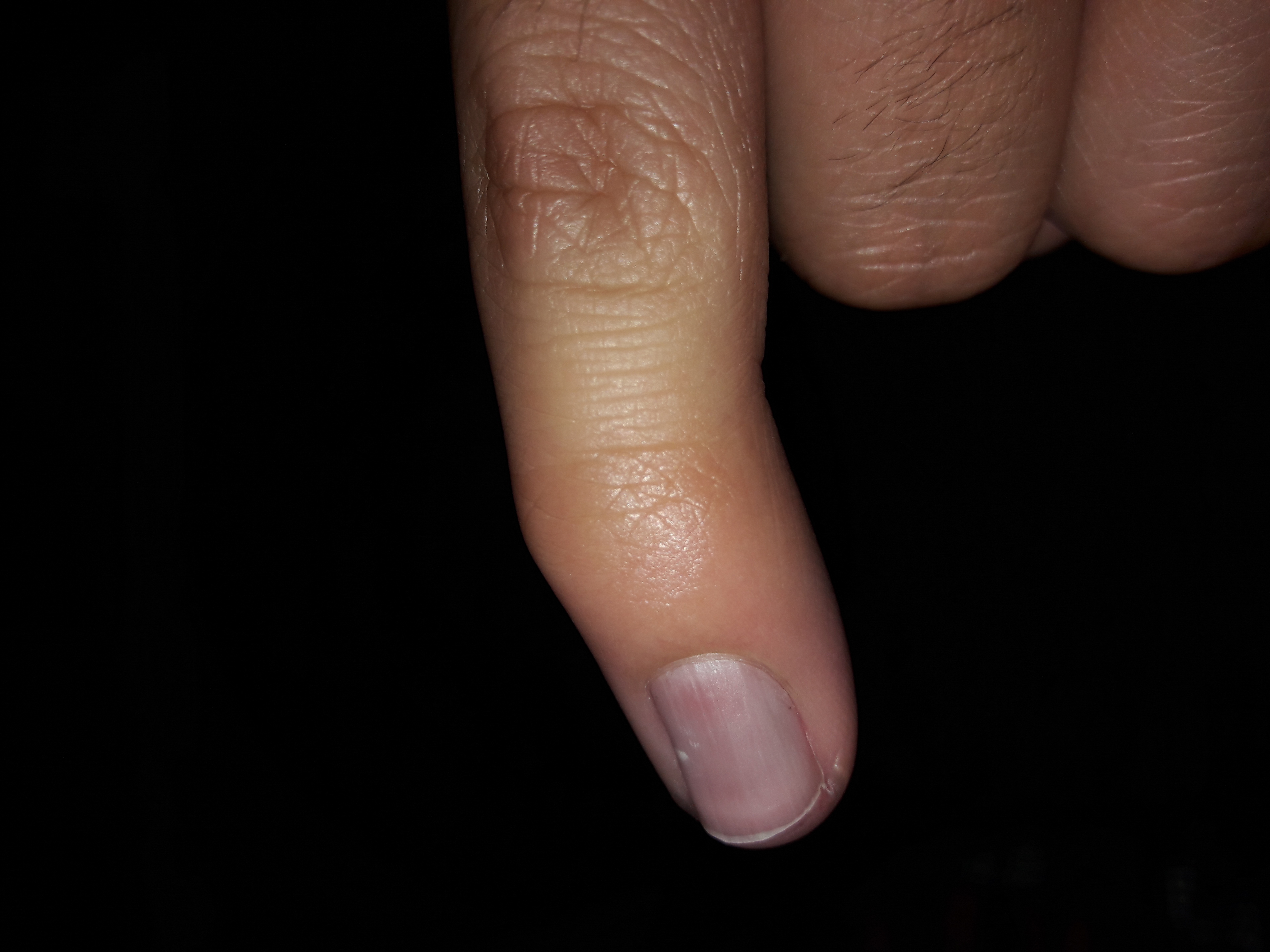 Finger In Tür Eingeklemmt Nagel Blau
