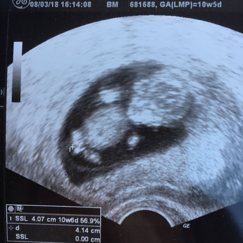 Wird Es Ein Junge Ooder Ein Madchen Schwangerschaft Schwanger Baby Wird Es Ein Junge Ooder Ein Madchen Schwangerschaft Schwanger Baby