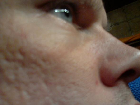 Wird Man Als Mann Mit Aknenarben Ein Leben Lang Alleine Bleiben Partnerschaft Narben Wird Man Als Mann Mit Aknenarben Ein Leben Lang Alleine Bleiben Partnerschaft Narben