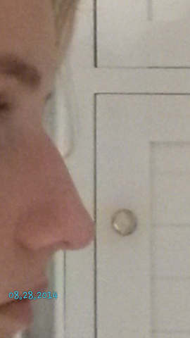 Wird Mein Buckel Auf Der Nase Noch Mehr Wachsen Freizeit Beauty