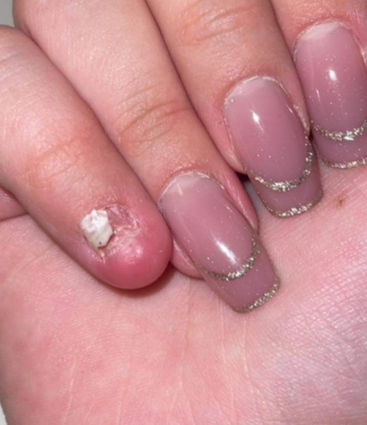 Wird mein Nagel nachwachsen? (Nägel, Finger, Fingernägel)