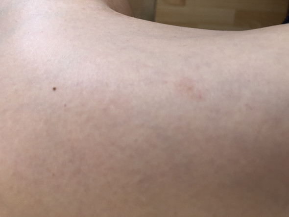 Wirklich ein Hautpilzkrankheit? Hilfe? (Gesundheit, Hautkrankheit) Wirklich ein Hautpilzkrankheit? Hilfe? (Gesundheit, Hautkrankheit)