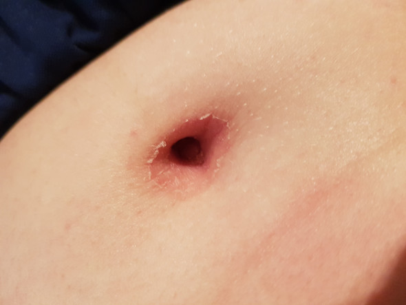 Wisst Ihr Was Das Ist Und Was Man Dagegen Machen Kann Gesundheit Und Medizin Bauchnabel Wisst Ihr Was Das Ist Und Was Man Dagegen Machen Kann Gesundheit Und Medizin Bauchnabel