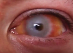 Wo Gibt Es Diese Kontaktlinsen Halloween Zombie