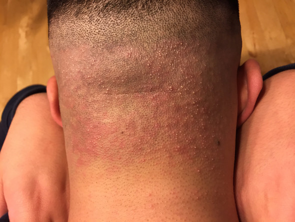 Wo Kommen Diese Pickel Her Und Wie Kriege Ich Sie Weg Gesundheit Und Medizin Haut Hinterkopf Wo Kommen Diese Pickel Her Und Wie Kriege Ich Sie Weg Gesundheit Und Medizin Haut Hinterkopf