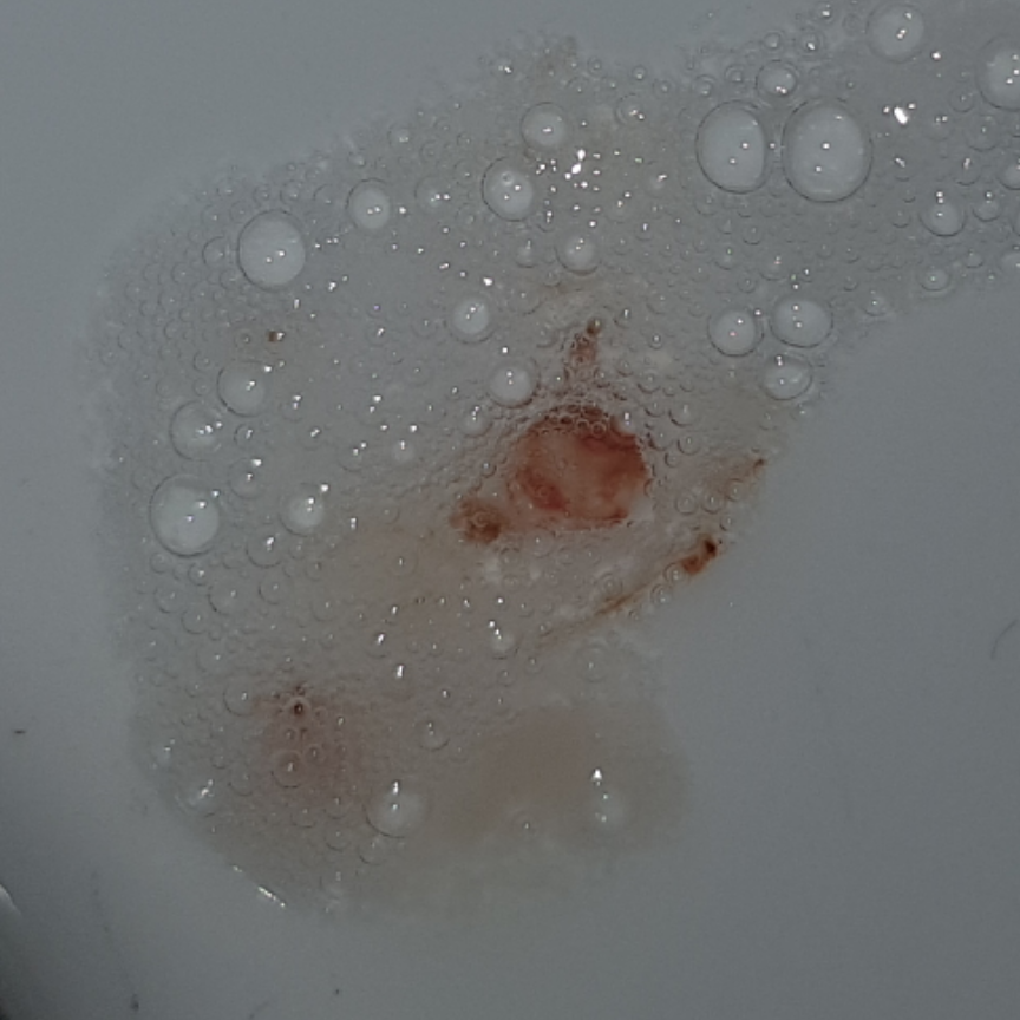 Woher Konnte Das Kommen Blut Mit Speichel Woher Konnte Das Kommen Blut Mit Speichel