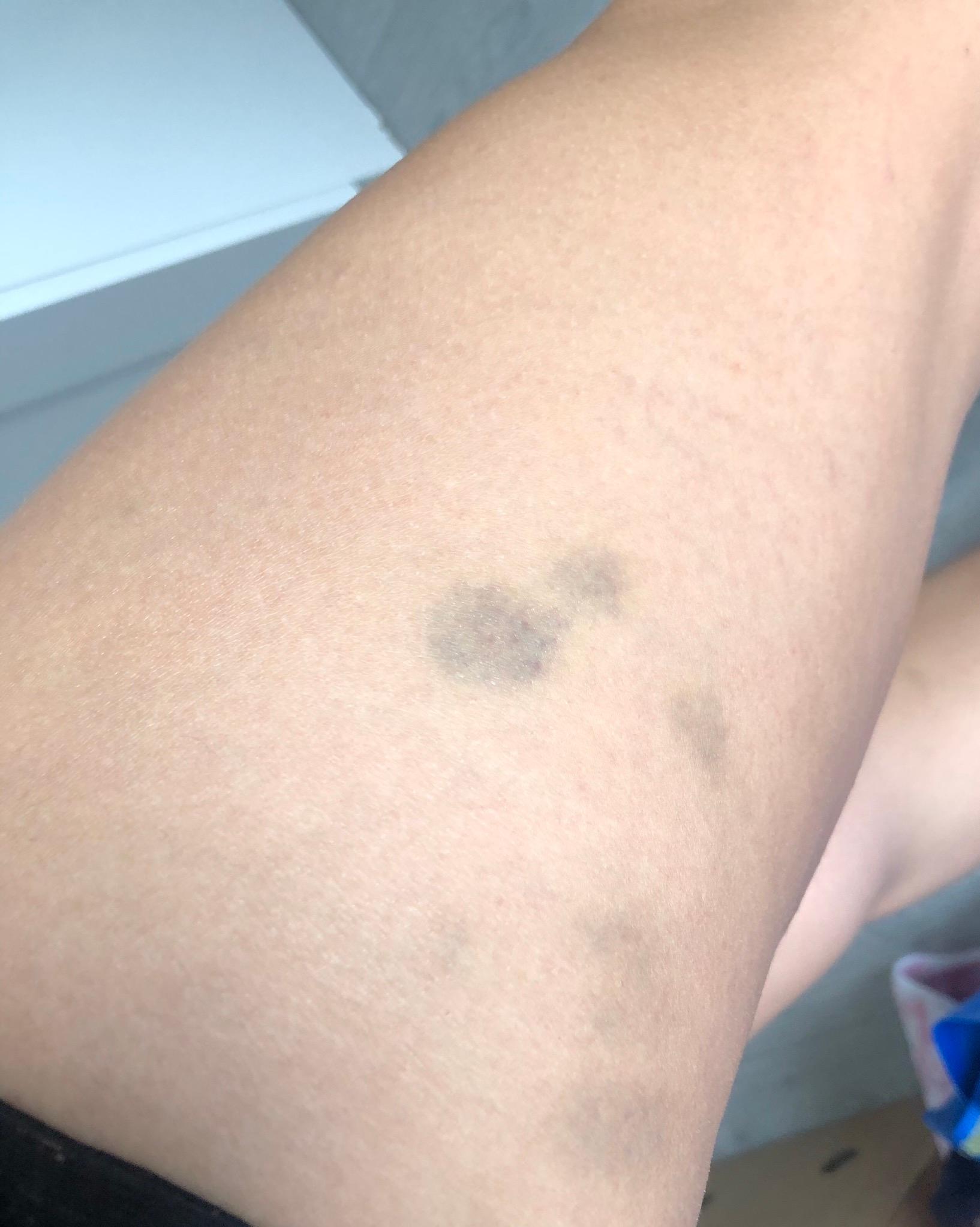 Woher kommen die blauen flecken? (Gesundheit und Medizin, blaueflecken) Woher kommen die blauen flecken? (Gesundheit und Medizin, blaueflecken)