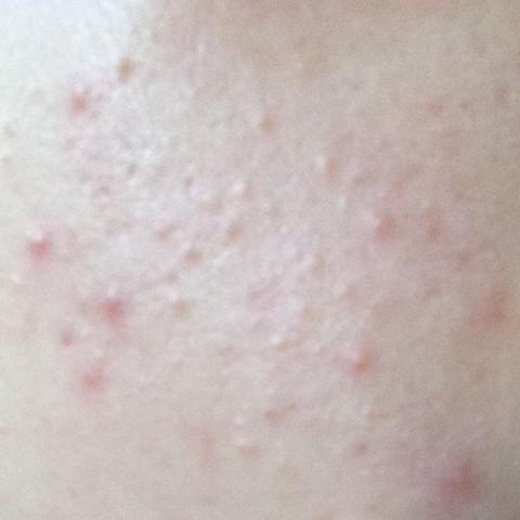 Woher Kommen Die Kleinen Pickel Auf Meiner Wange Haut Gesicht Akne