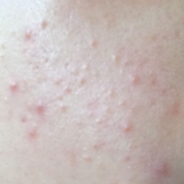 48+ Kleine Pickel Im Mundwinkel PNG