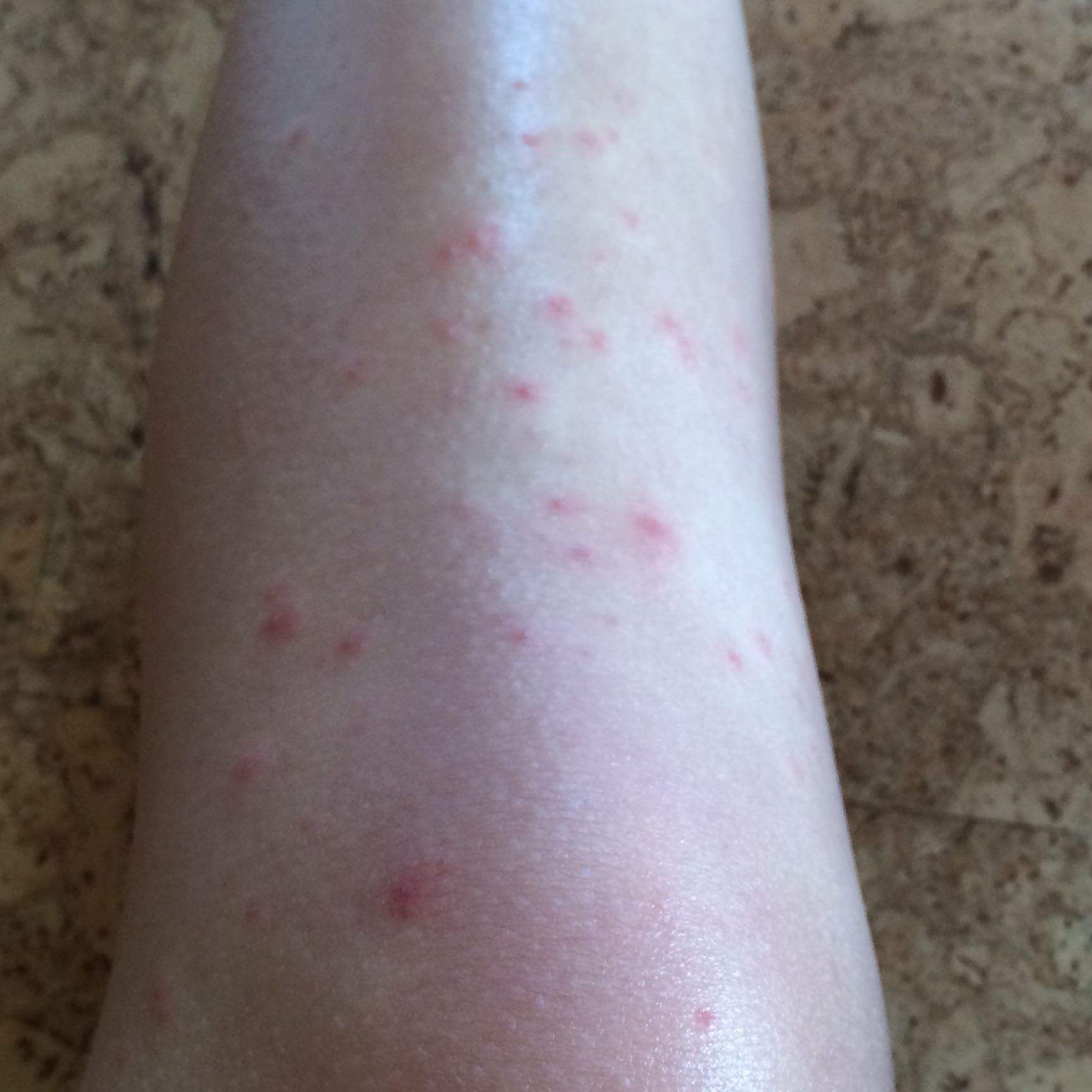 pickel auf den beinen pickel auf den beinen