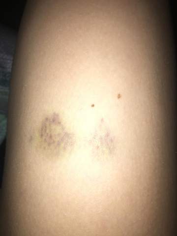 Woher kommen plötzlich diese blauen Flecken? (Gesundheit und Medizin, blauer Fleck)