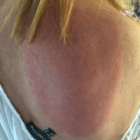 #roterfleck - (Körper, Haut, Allergie)
