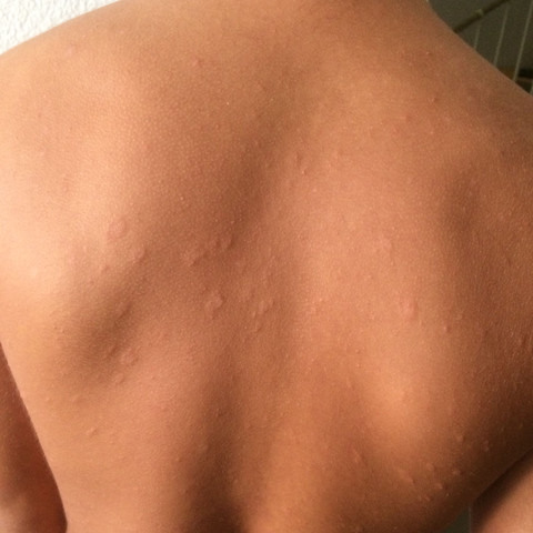 Flecken auf dem Rücken - (Körper, Krankheit, Allergie)