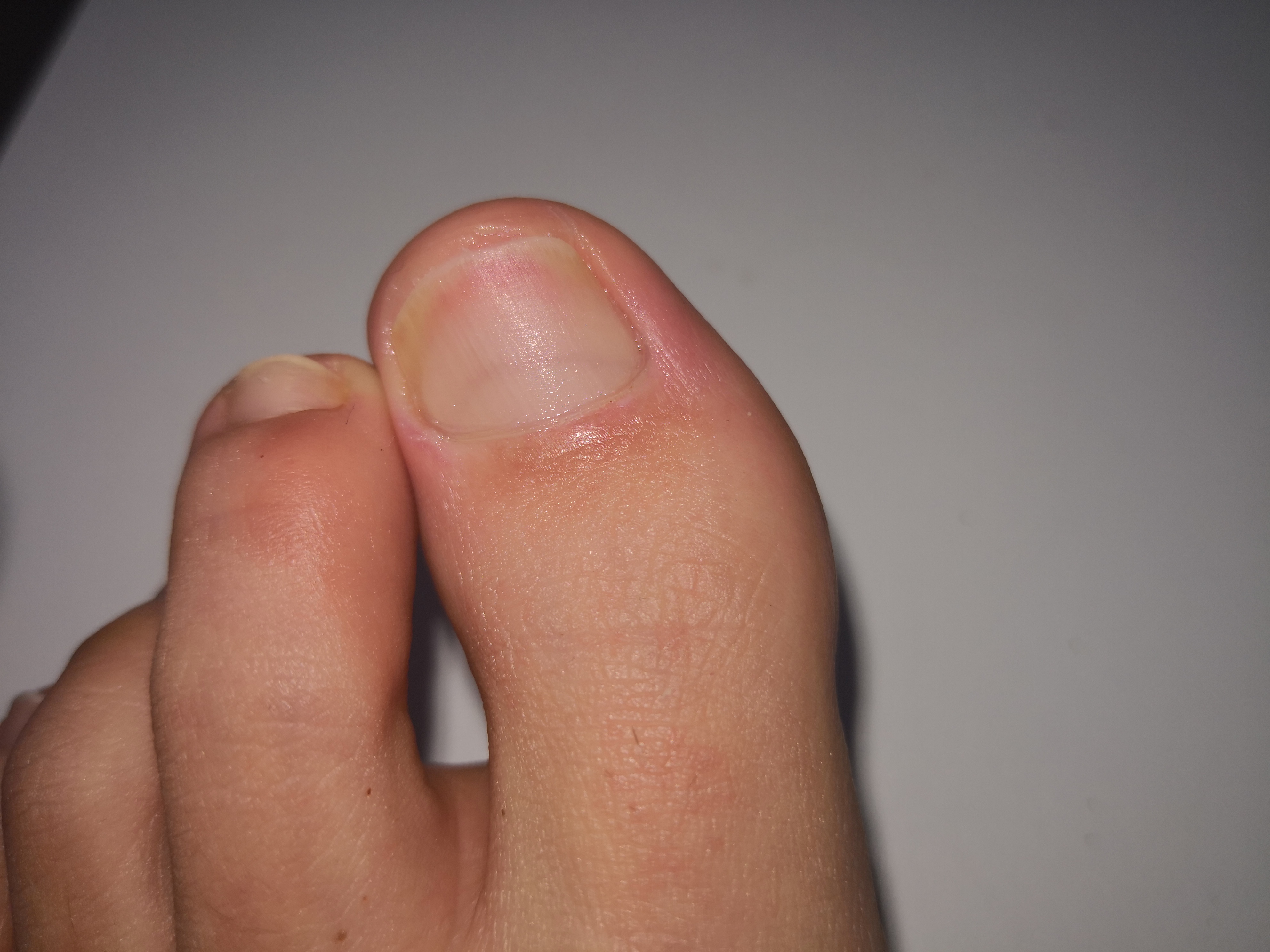 Woran Erkenne Ich Das Der Negelpilz Abheilt Gesundheit Und Medizin Nagelpilz Woran Erkenne Ich Das Der Negelpilz Abheilt Gesundheit Und Medizin Nagelpilz