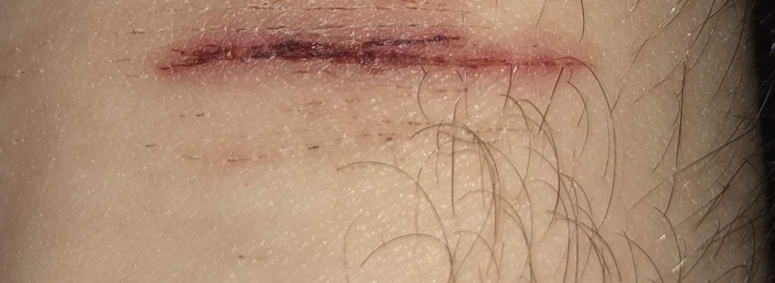 Woran erkennt man eine blutvergiftung genau? (Wunde, Tetanus, Sepsis) Woran erkennt man eine blutvergiftung genau? (Wunde, Tetanus, Sepsis)