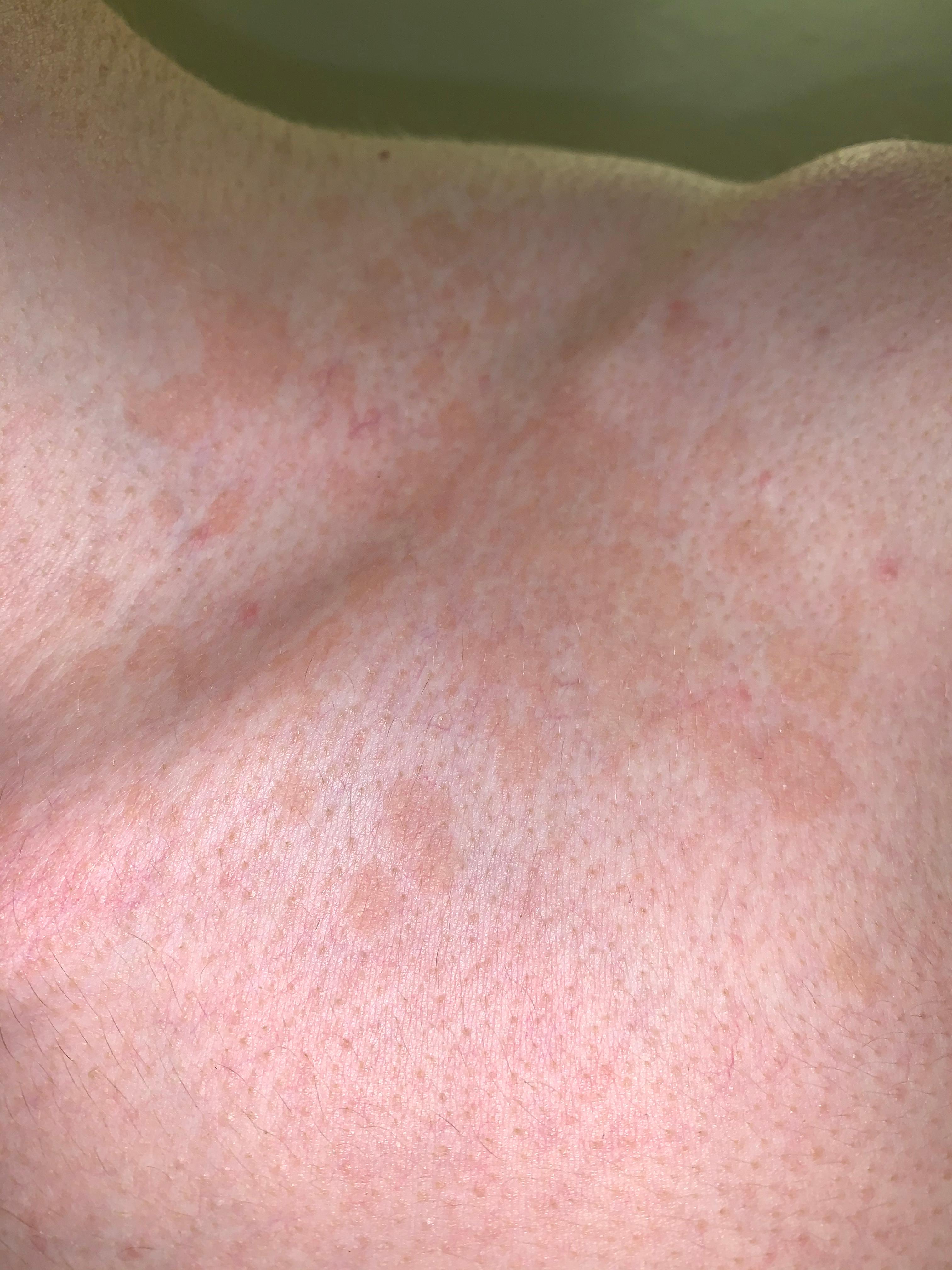 Worauf können diese Flecken über der Brust hinweisen? (Gesundheit und Medizin, Haut, Hautarzt) Worauf können diese Flecken über der Brust hinweisen? (Gesundheit und Medizin, Haut, Hautarzt)
