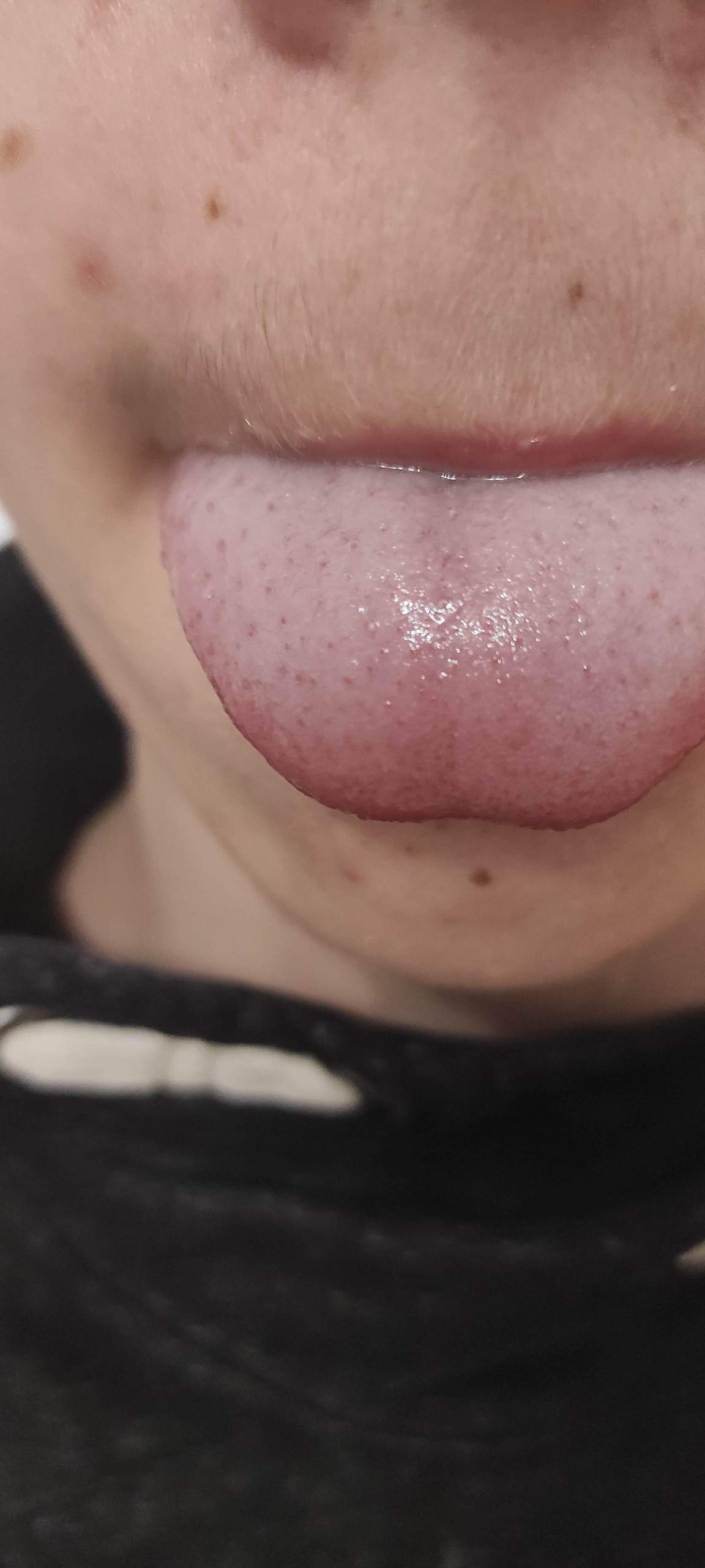 Zunge eiterbläschen Eiterpickel im