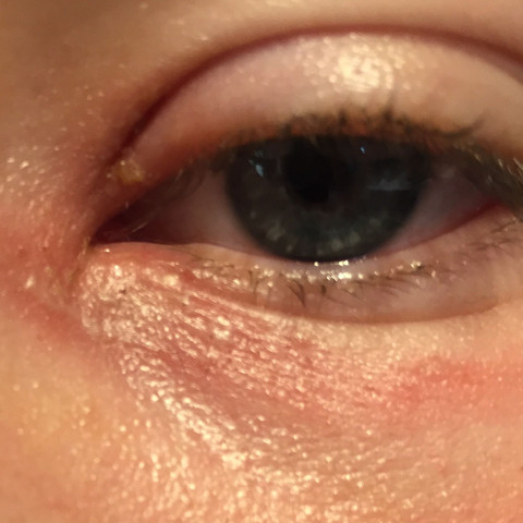 Ws Kann Das Sein Am Auge Rot Eiter Schmerzhaft Ws Kann Das Sein Am Auge Rot Eiter Schmerzhaft
