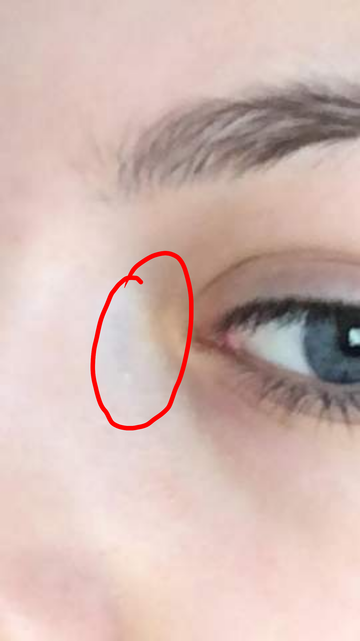 Wie Bekommt Man Ein Blaues Auge Weg
