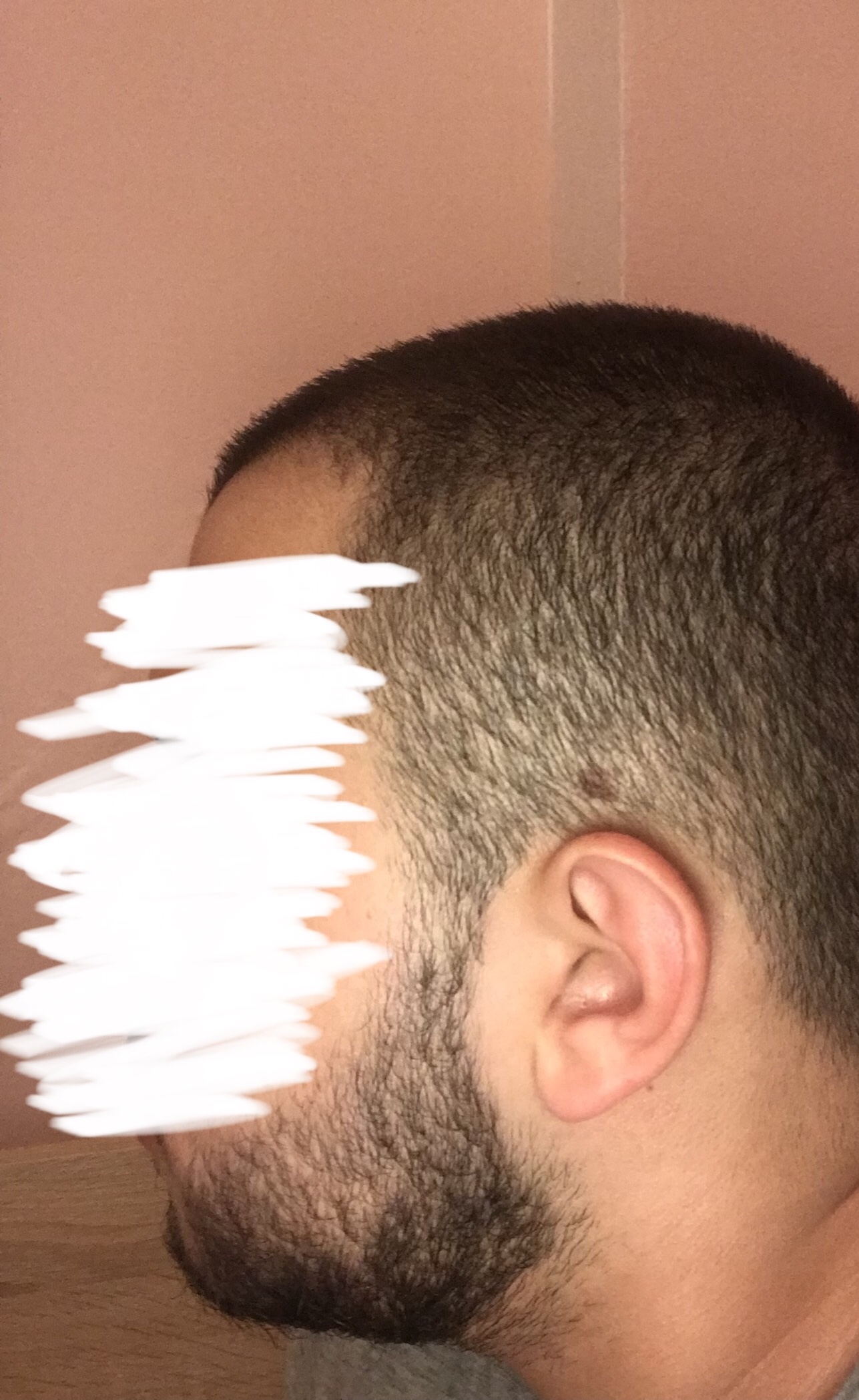 lohnen dieses muttermal zu entfernen