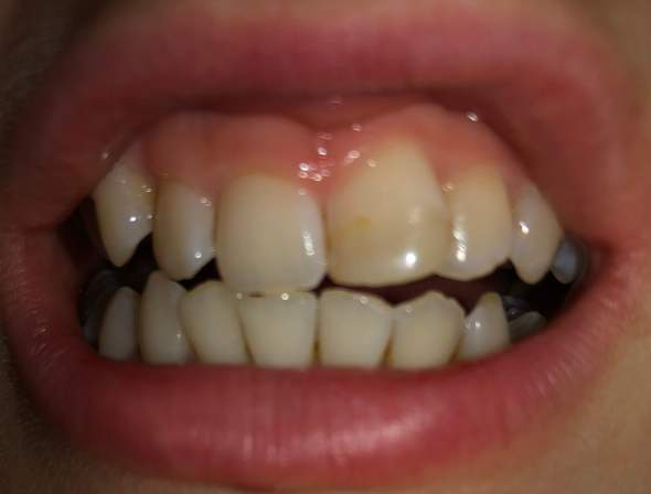 Würden euch solche Zähne bei Partner/in stören?