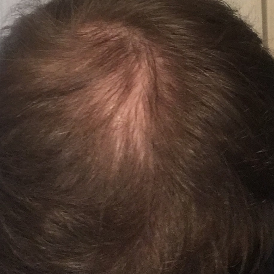 schüsslersalze haarausfall