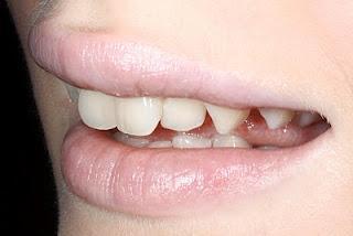 Zähne - (Zähne, Zahnspange, Kieferorthopäde)