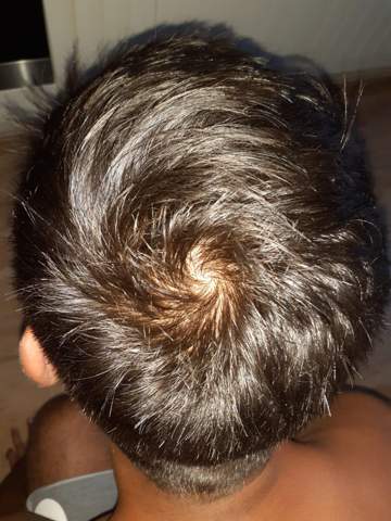 Wurdet Ihr Sagen Ich Kriege Eine Glatze Haare Haarausfall