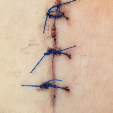 Wund Nach Dem Faden Ziehen Auf Ist Das Normal Schmerzen Operation Knie Wund Nach Dem Faden Ziehen Auf Ist Das Normal Schmerzen Operation Knie