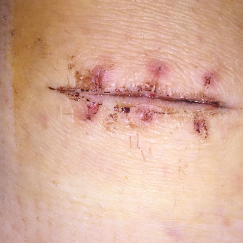 Wund Nach Dem Faden Ziehen Auf Ist Das Normal Schmerzen Operation Knie Wund Nach Dem Faden Ziehen Auf Ist Das Normal Schmerzen Operation Knie