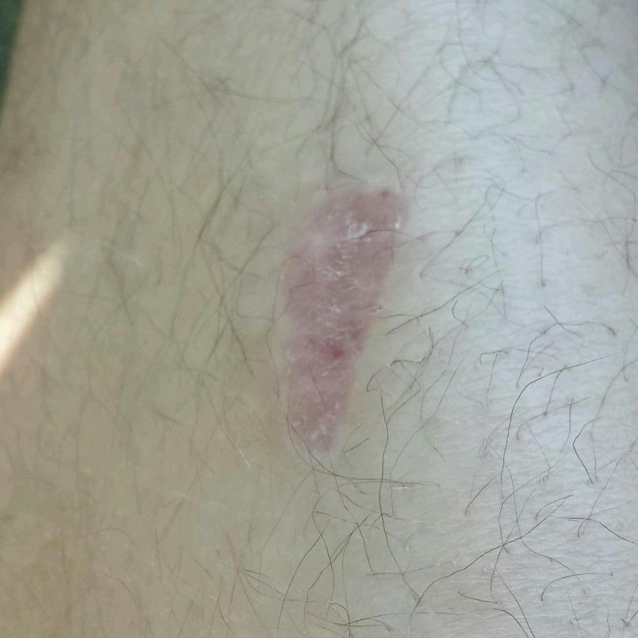 Wunde! Bleibt es eine narbe? (Narben)