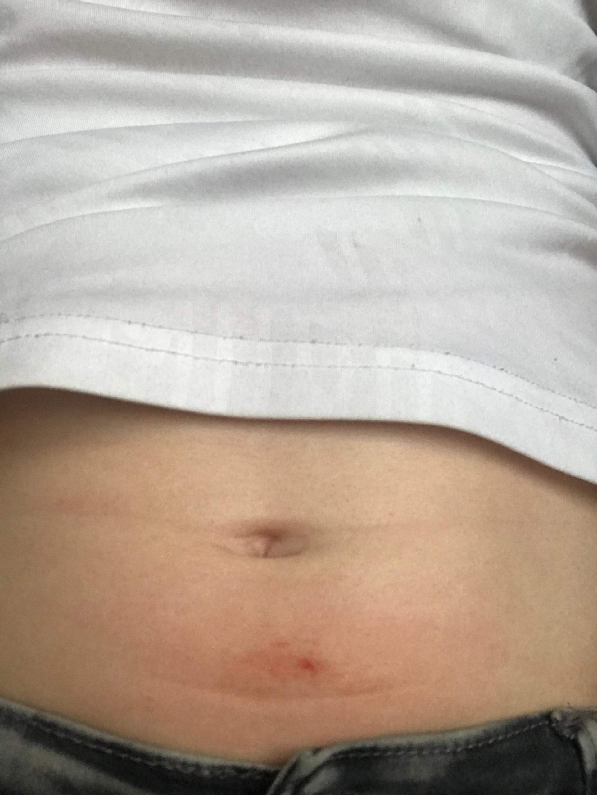 Wunde am Bauch und gut sichtbares Blut unter der Haut, was tun (mit