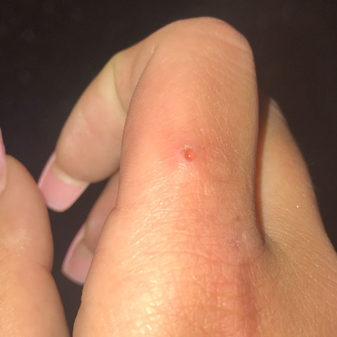 Wunde Am Finger Verheilt Nicht Mehr Eiter Wunde Am Finger Verheilt Nicht Mehr Eiter