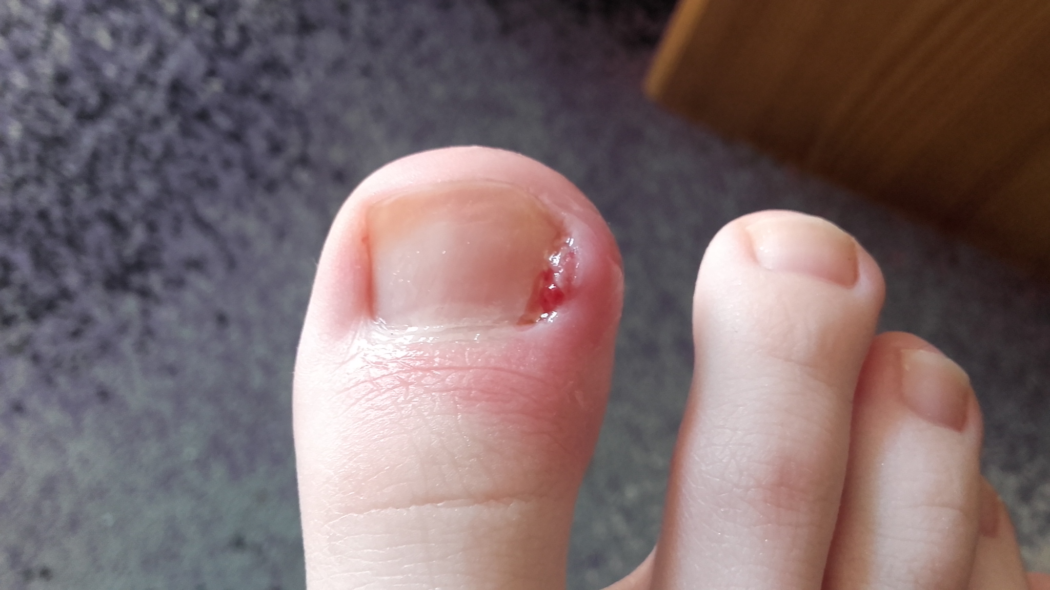 Wunde Am Fusszeh Will Nicht Heilen Was Soll Ich Tun Pilzinfektion Bindehautentzundung