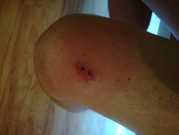 Wunde Am Oberschenkel Normal Gesundheit Und Medizin Entzundet Wundheilung Wunde Am Oberschenkel Normal Gesundheit Und Medizin Entzundet Wundheilung